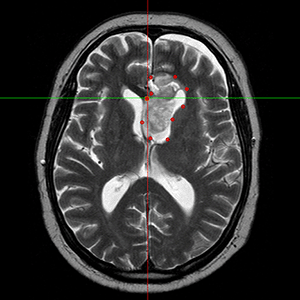 MRI-deformation-300px.gif